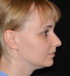 Rhinoplasty case #15192