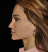 Rhinoplasty case #15187