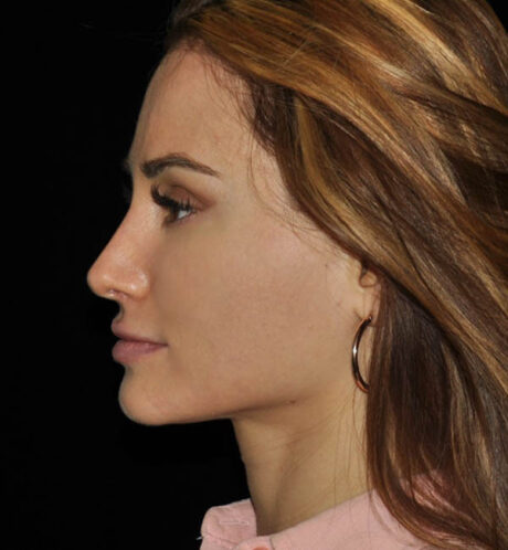 Rhinoplasty case #15187