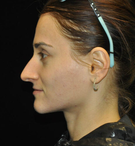 Rhinoplasty case #15187