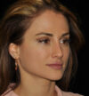 Rhinoplasty case #15187