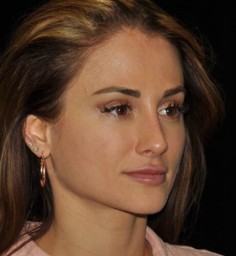 Rhinoplasty case #15187
