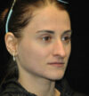 Rhinoplasty case #15187