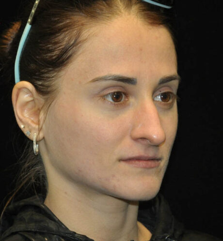 Rhinoplasty case #15187