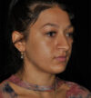 Rhinoplasty case #15182