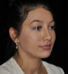 Rhinoplasty case #15182