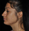 Rhinoplasty case #15182