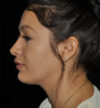 Rhinoplasty case #15182