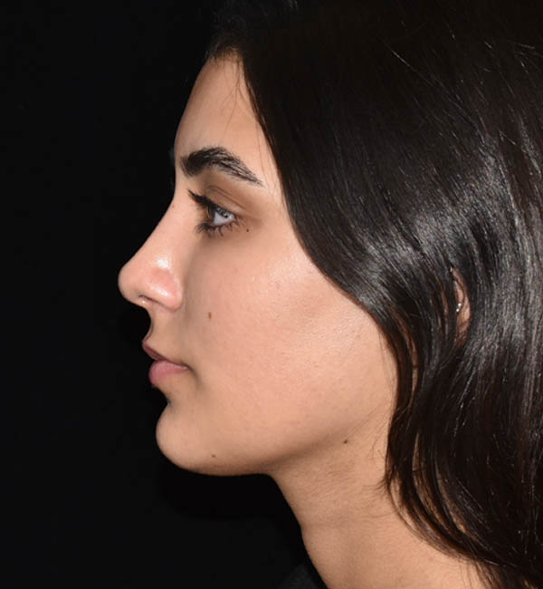 Rhinoplasty case #15260