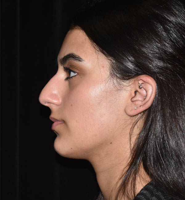 Rhinoplasty case #15260