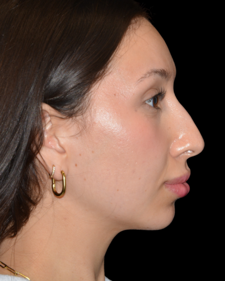 Buccal Fat Removal case #15811