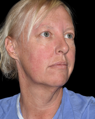 Facelift case #15798