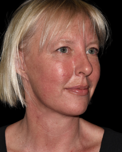 Facelift case #15798