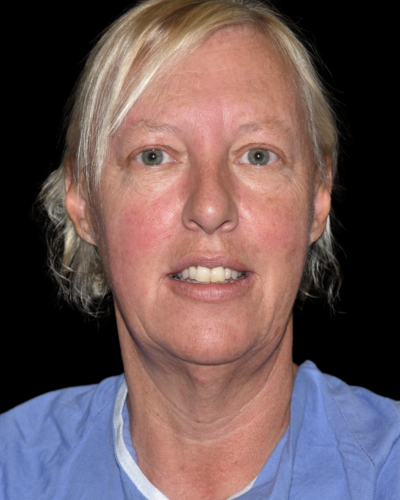 Facelift case #15798