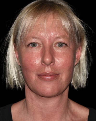 Facelift case #15798