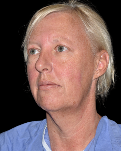 Facelift case #15798