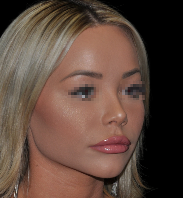 Rhinoplasty case #15799