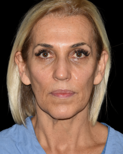 Facelift case #15779