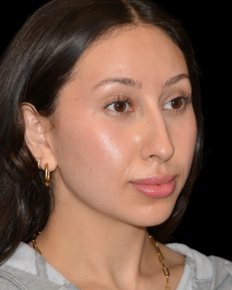 Buccal Fat Removal case #15811