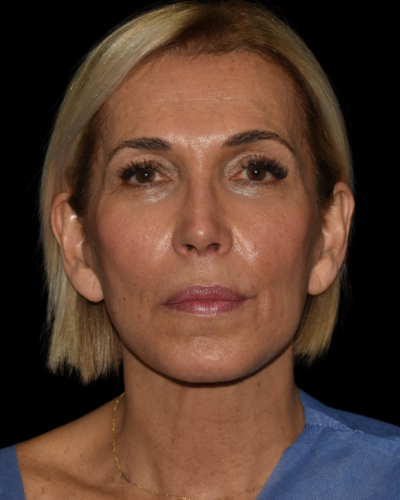 Facelift case #15779