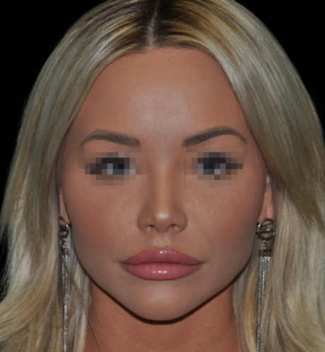 Rhinoplasty case #15799