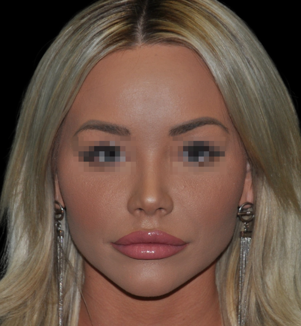 Rhinoplasty case #15799