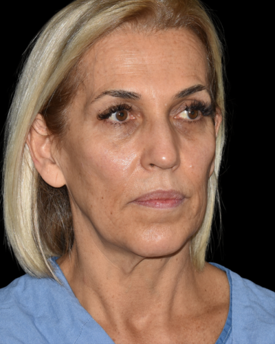 Facelift case #15779