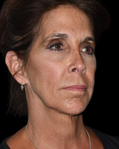 Facelift case #15797