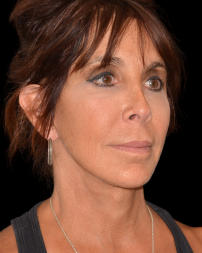 Facelift case #15797