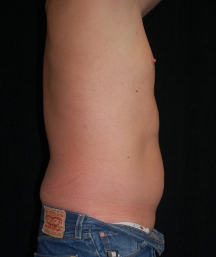 Before thumbnail for Case 20 Liposuction Before and After Photos
