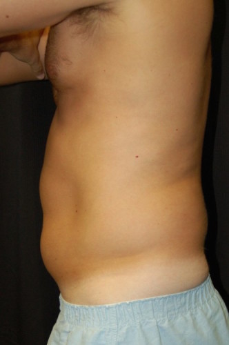 Before thumbnail for Case 21 Liposuction Before and After Photos