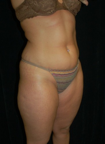 Before thumbnail for Case 18 Liposuction Before and After Photos