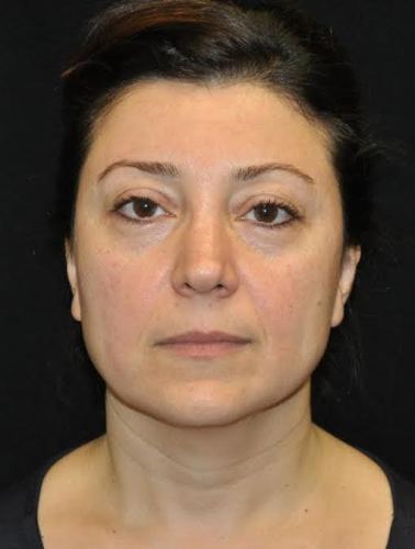 Before thumbnail for Case 19 Blepharoplasty (Upper Eyelid Lift) Before and After Photos