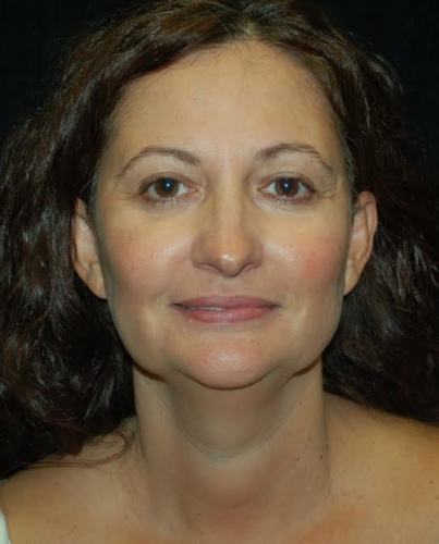 Before thumbnail for Case 7 Blepharoplasty (Upper Eyelid Lift) Before and After Photos