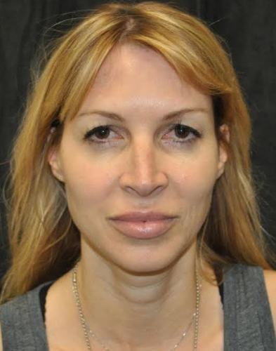 Before thumbnail for Case 10 Blepharoplasty (Upper Eyelid Lift) Before and After Photos