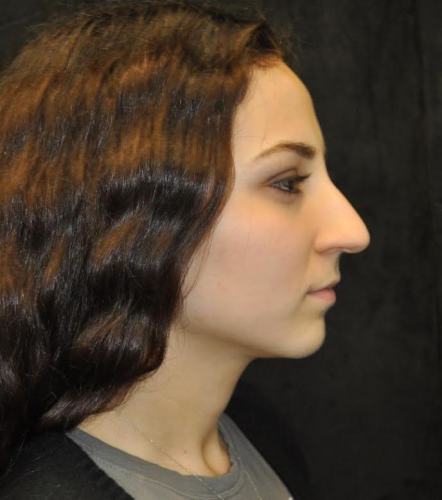 Before thumbnail for Case 105 Rhinoplasty Before and After Photos