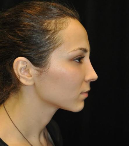 After thumbnail for Case 105 Rhinoplasty Before and After Photos