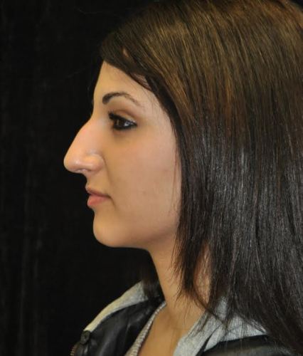Before thumbnail for Case 106 Rhinoplasty Before and After Photos