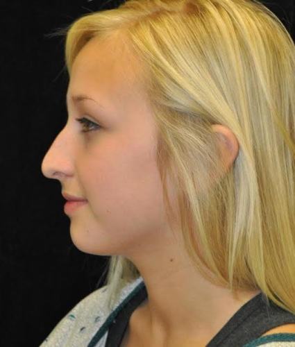 Before thumbnail for Case 107 Rhinoplasty Before and After Photos