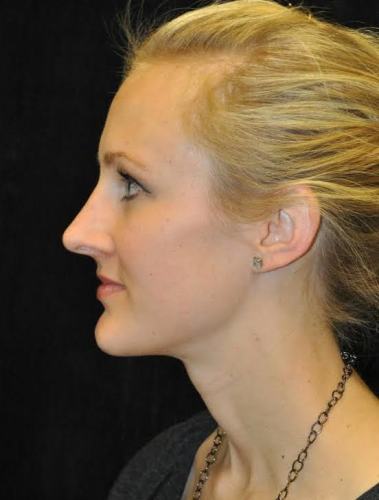 Before thumbnail for Case 109 Rhinoplasty Before and After Photos