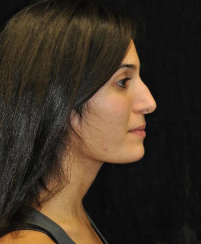 Before thumbnail for Case 113 Rhinoplasty Before and After Photos