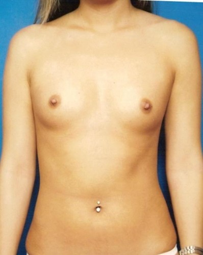 Before thumbnail for Case 32 Breast Augmentation Before and After Photos