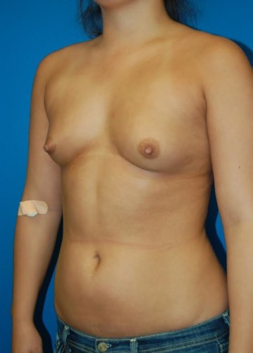 Before thumbnail for Case 29 Breast Augmentation Before and After Photos