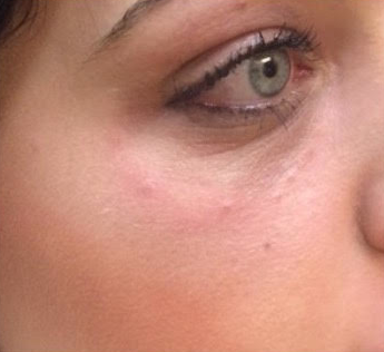 After thumbnail for 6 Dermal Fillers Before and After Photos