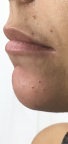 After thumbnail for 7 Dermal Fillers Before and After Photos