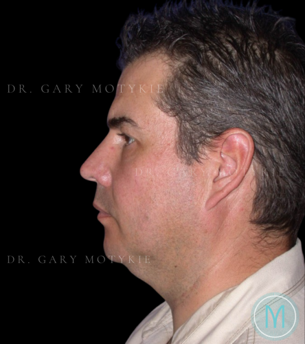 Before thumbnail for Case 1 Neck Lift Before and After Photos