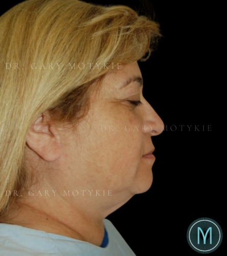 Before thumbnail for Case 4 Neck Lift Before and After Photos