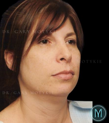 Before thumbnail for Case 6 Neck Lift Before and After Photos