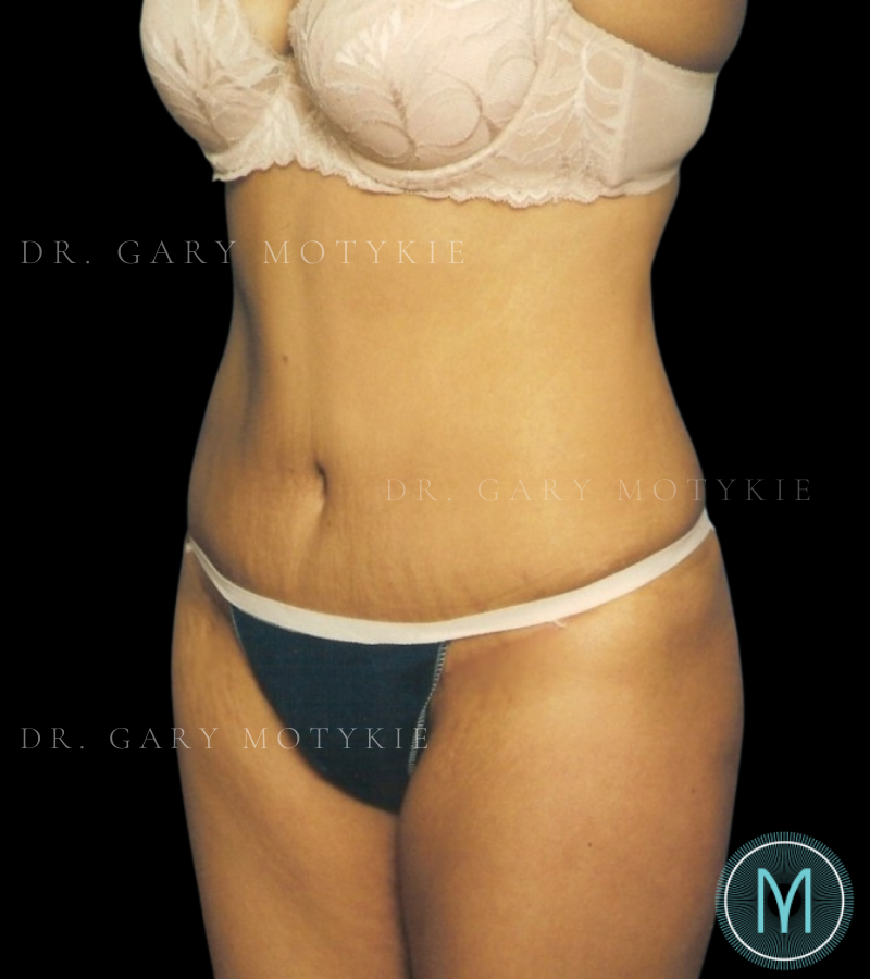 After thumbnail for Case 1 Tummy Tuck Before and After Photos