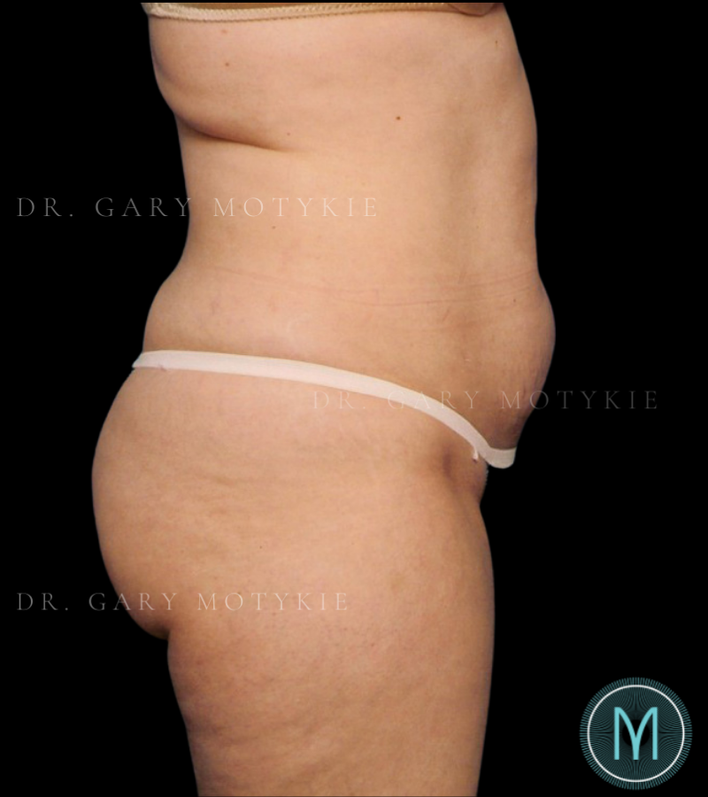Before thumbnail for Case 2 Tummy Tuck Before and After Photos